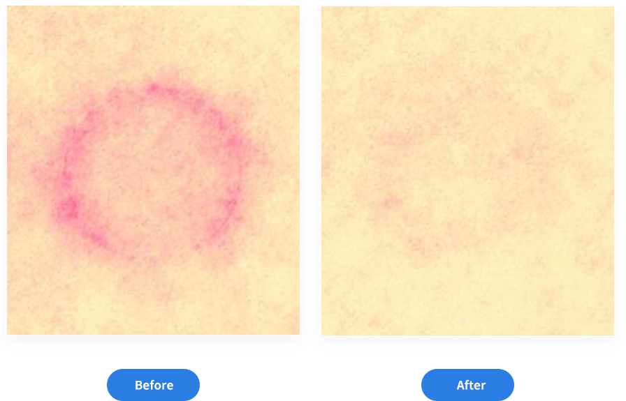 Podocon Application Rash Korea Institute Of Dermatological Sciences